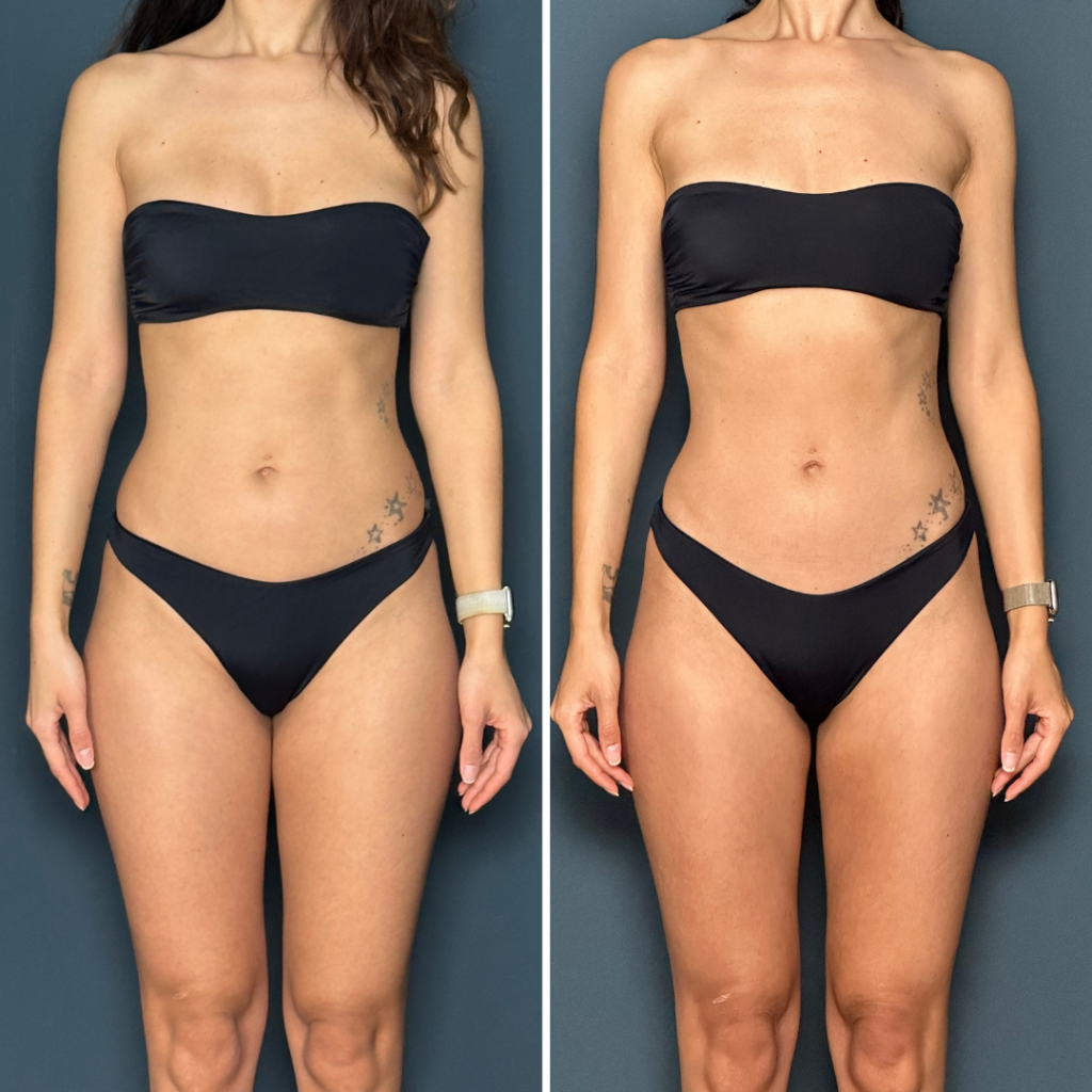 lean legs program transformation